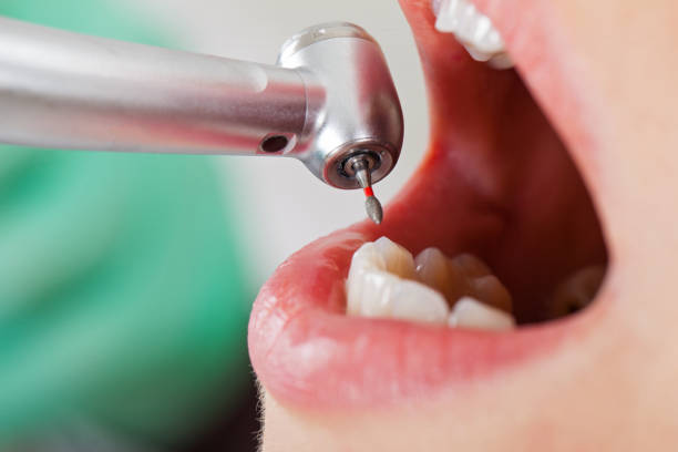 Best Broken or Cracked Tooth Emergency Dentist in Pikeville, TN
